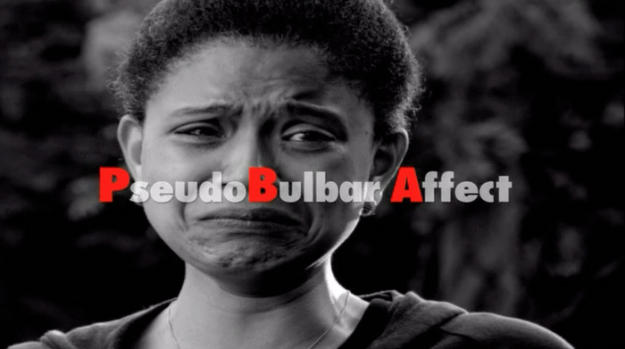 PsudobulbarAffect-Jan2013.mp4